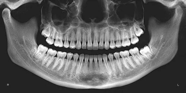 Do dental x-rays produce a lot of radiation?