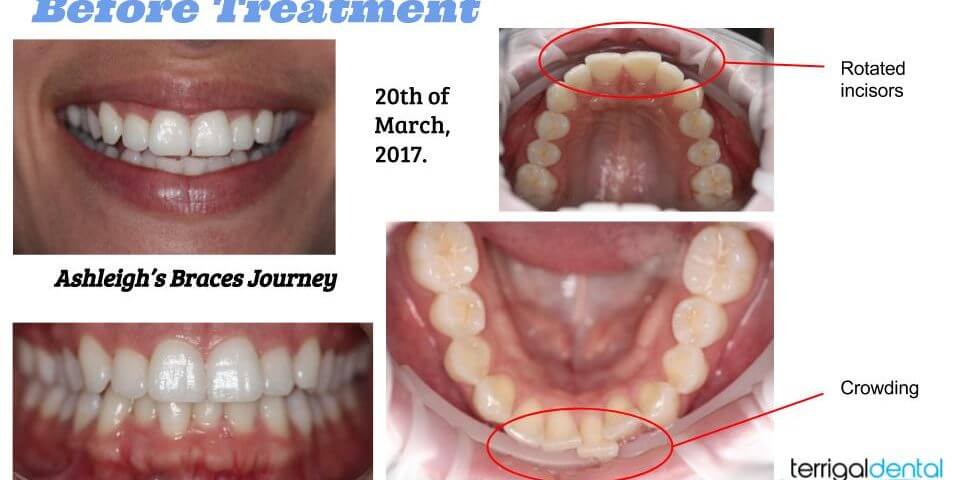 Ash’s Orthodontic Treatment
