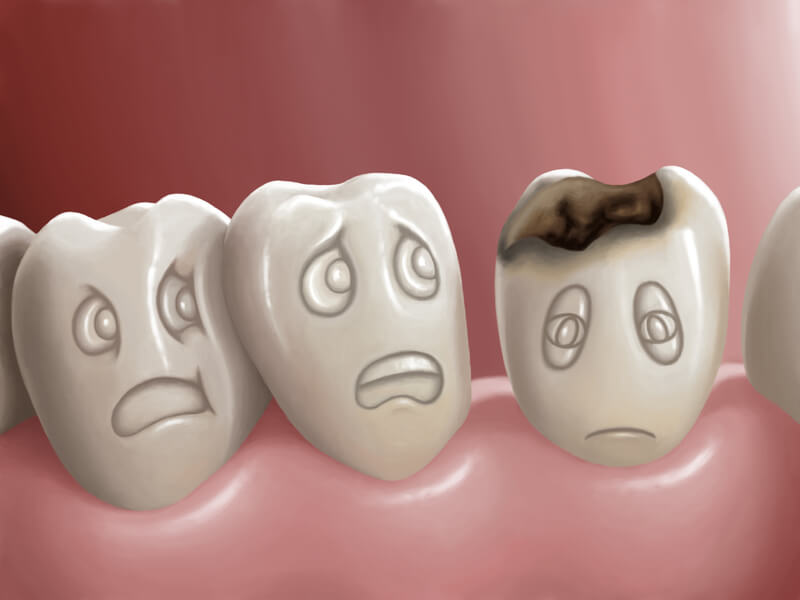 What causes cavities?