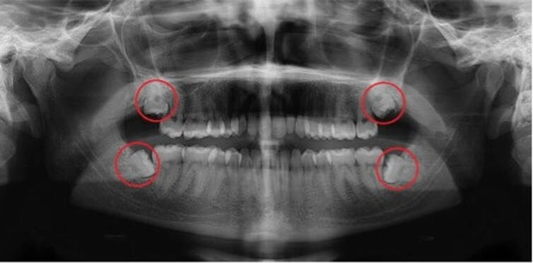 Wisdom Teeth – All you need to know!